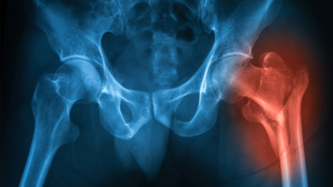 The Secret Weapon for Hip Fracture Surgery Recovery