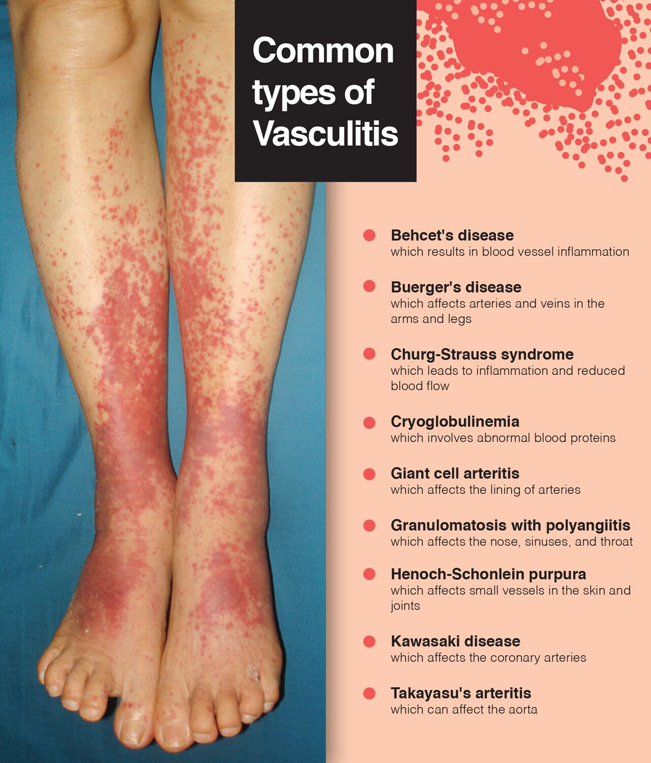 Early detection is the best way to prevent vasculitis