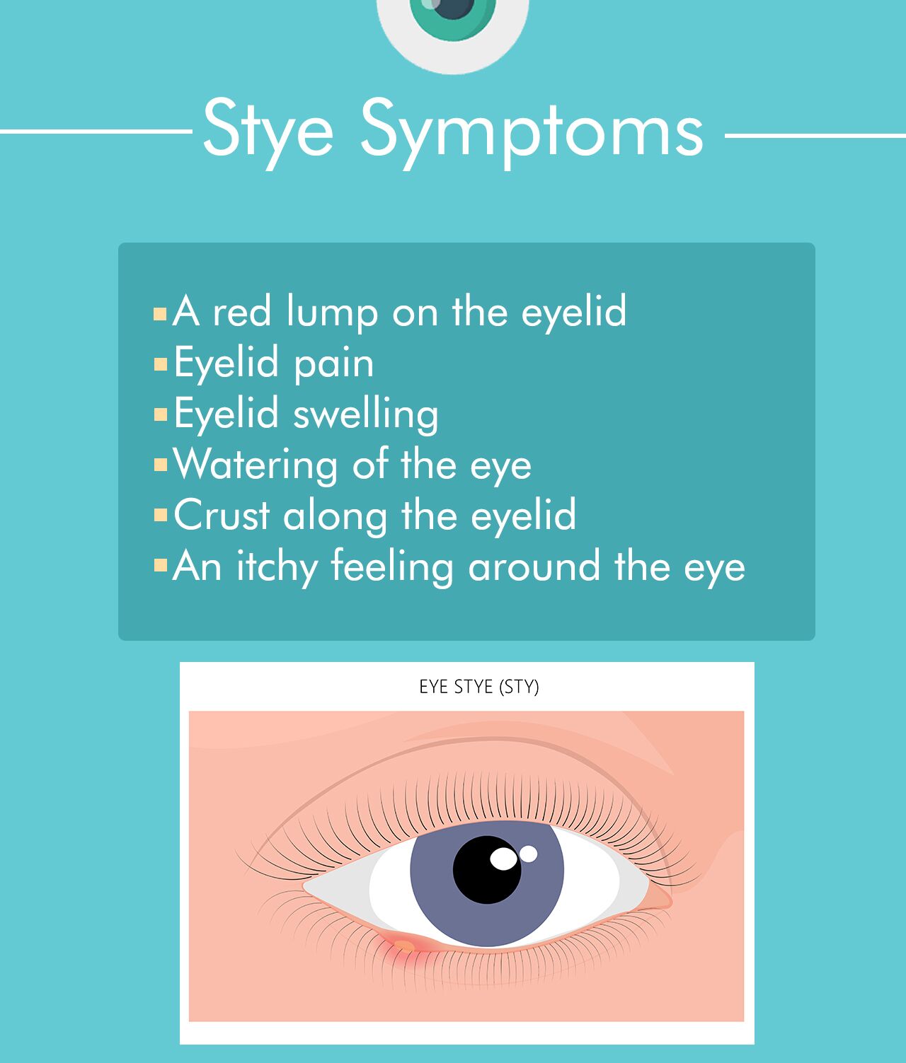 Symptoms of a stye
