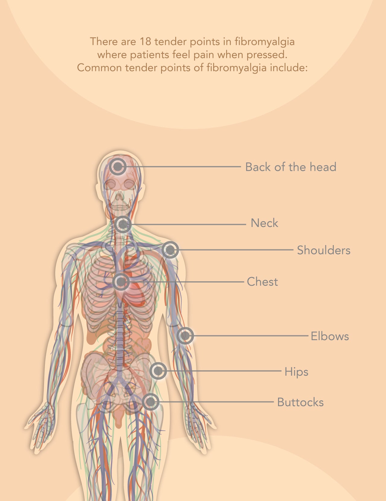 Fibromyalgia tender points