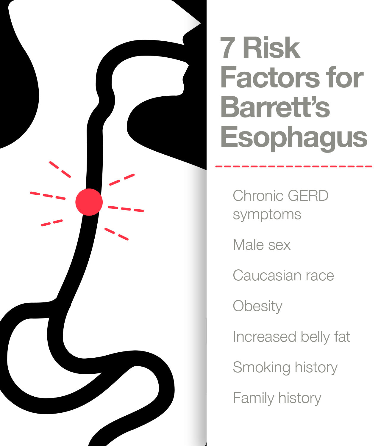 Risk factors for Barrett’s esophagus