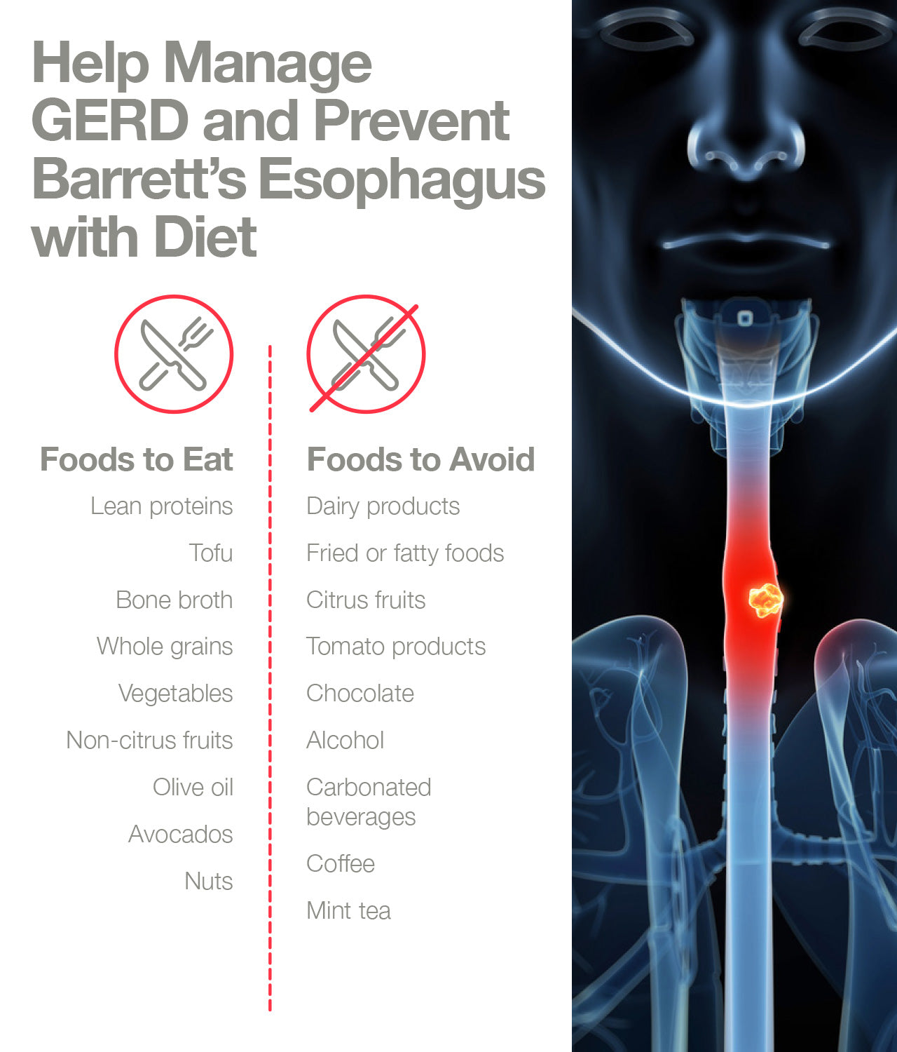 Prevention foods for GERD