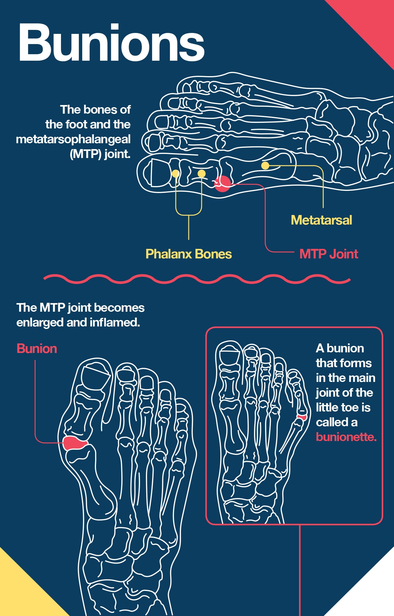 How bunions form