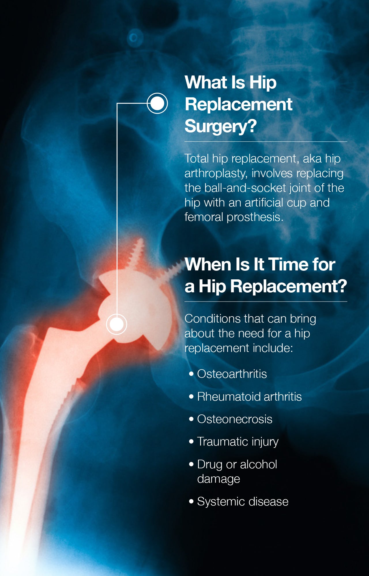 The Step-by-Step Guide to Hip Replacement Recovery