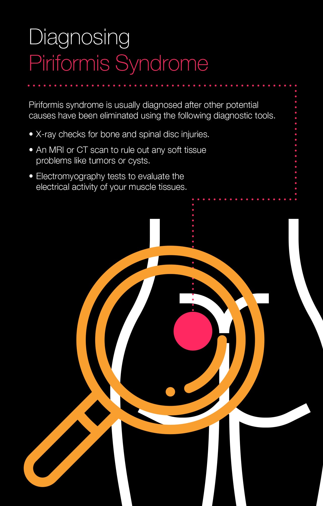 Diagnosing Piriformis Syndrome