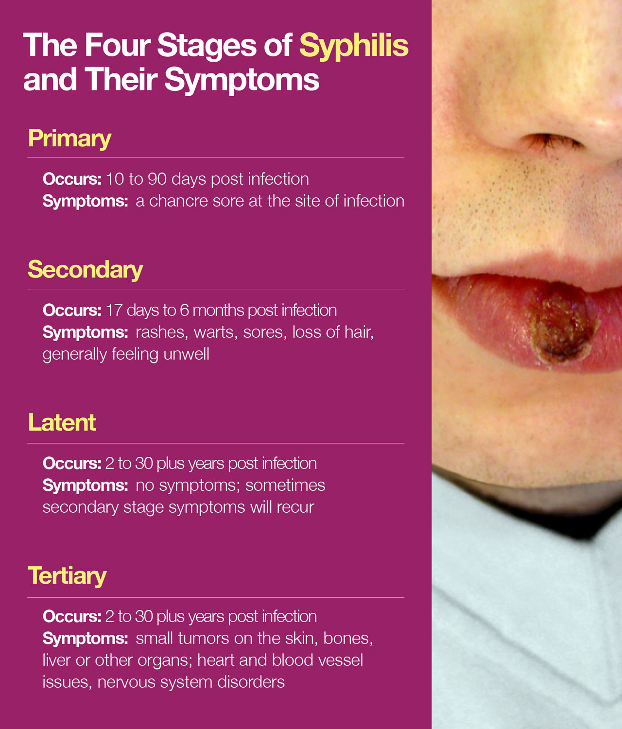 4 stages of syphilis and their symptoms