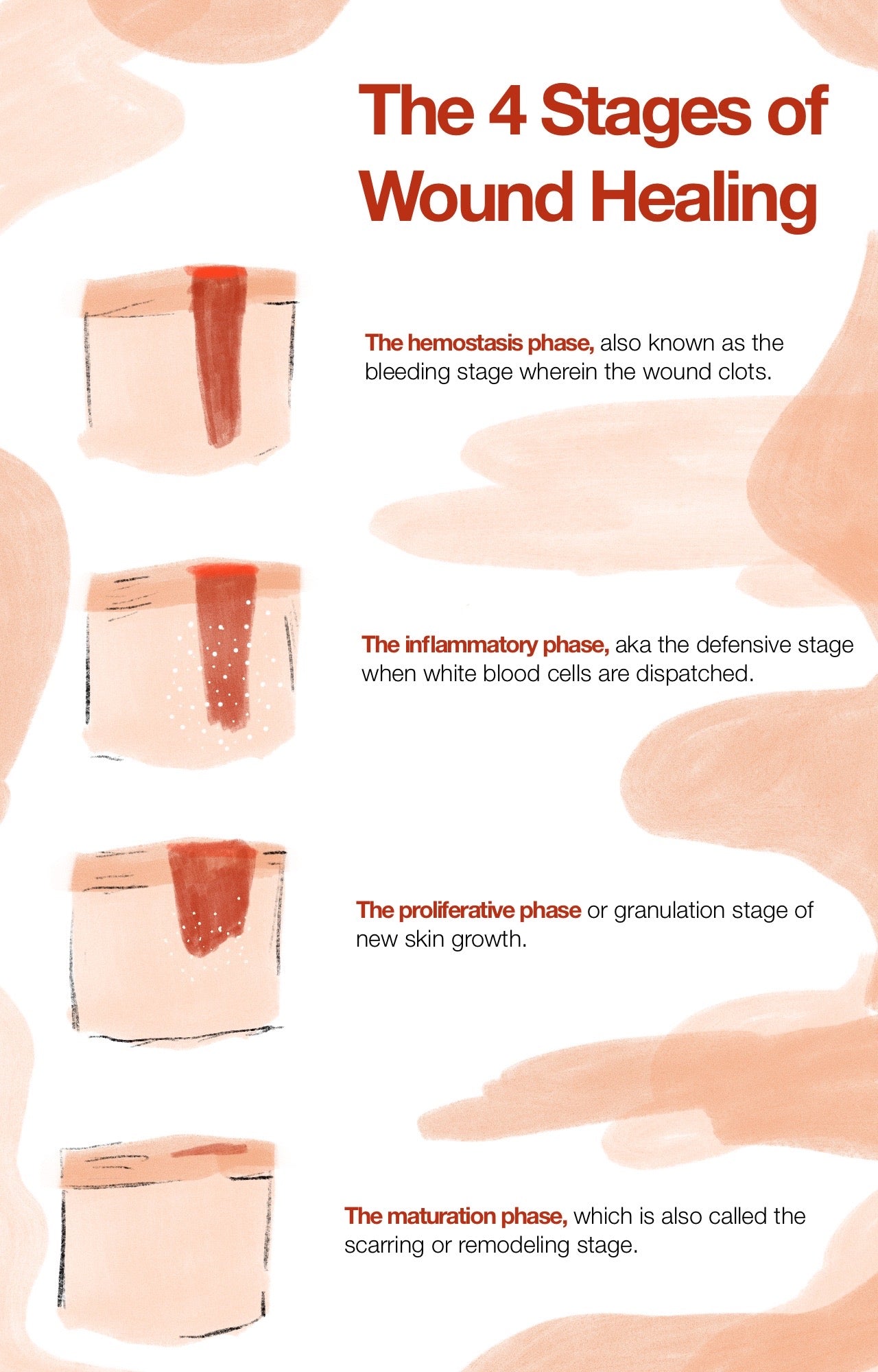 The 4 Stages of Wound Healing